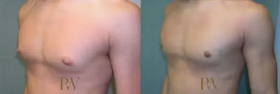 Paul Wilson - Male Breast Reduction Patient Image 5