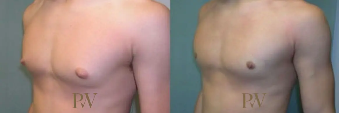 Paul Wilson - Male Breast Reduction Patient Image 5