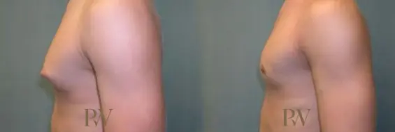Paul Wilson - Male Breast Reduction Patient Image 6
