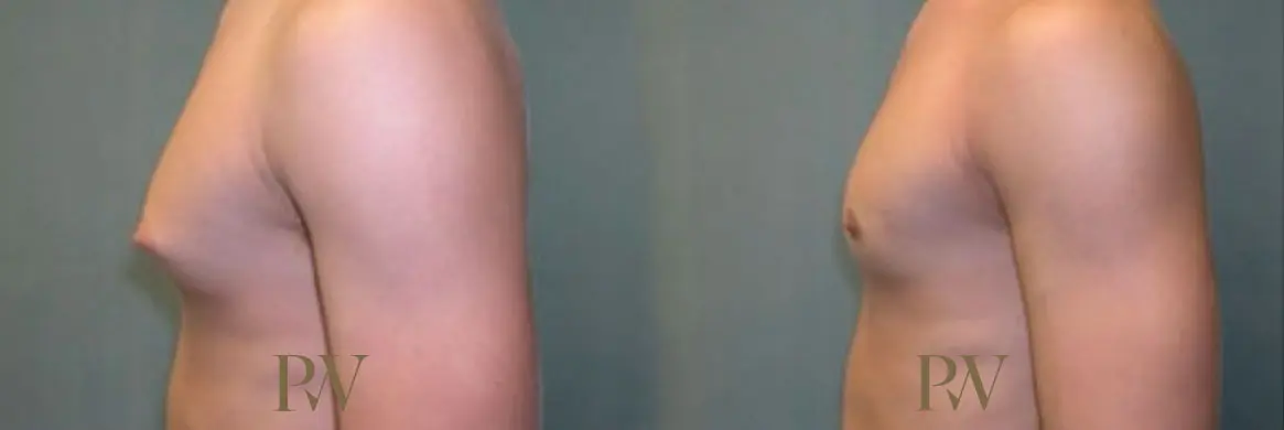 Paul Wilson - Male Breast Reduction Patient Image 6