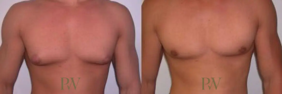 Paul Wilson - Male Breast Reduction Patient Image 7