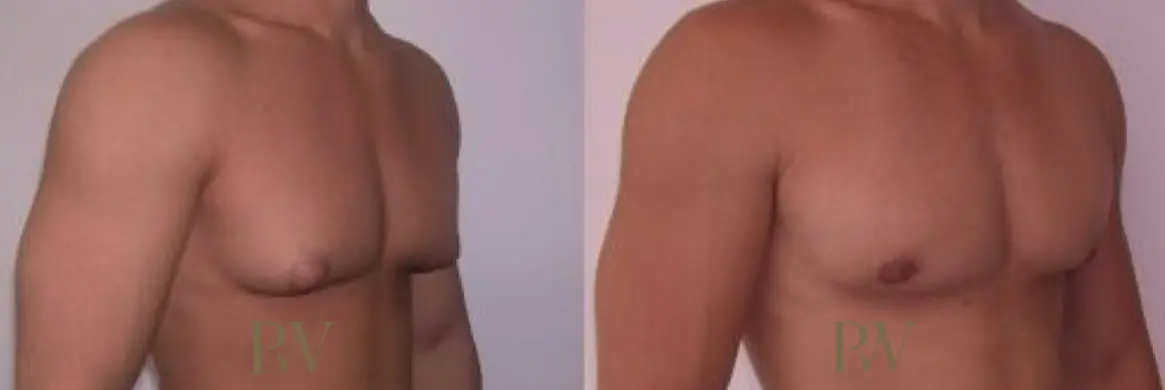 Paul Wilson - Male Breast Reduction Patient Image 8