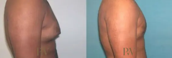 Paul Wilson - Male Breast Reduction Patient Image 9