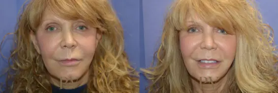 Paul Wilson - Mid-Face Lift Patient Image 1