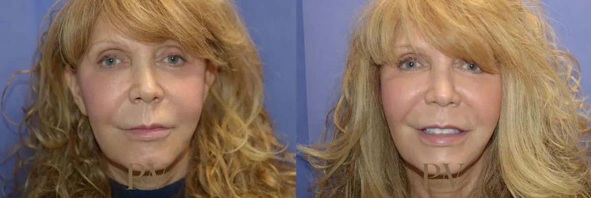 Paul Wilson - Mid-Face Lift Patient Image 1