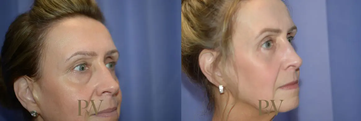 Paul Wilson - Mid-Face Lift Patient Image 10