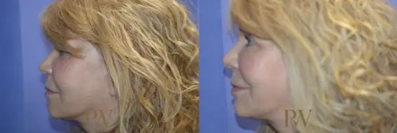 Paul Wilson - Mid-Face Lift Patient Image 2