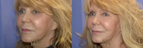 Paul Wilson - Mid-Face Lift Patient Image 3