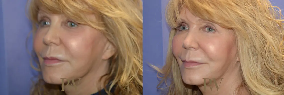 Paul Wilson - Mid-Face Lift Patient Image 3