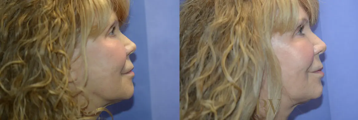 Paul Wilson - Mid-Face Lift Patient Image 4