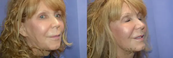 Paul Wilson - Mid-Face Lift Patient Image 5