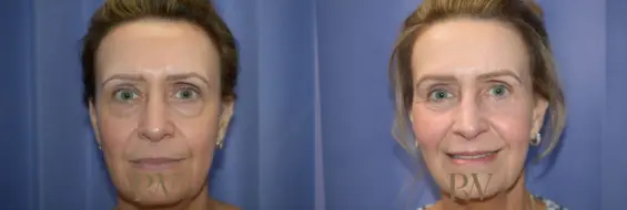 Paul Wilson - Mid-Face Lift Patient Image 6