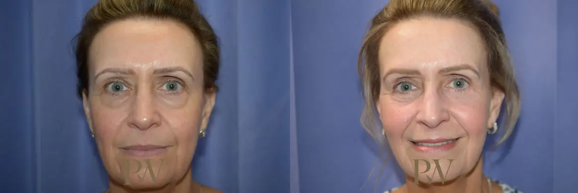 Paul Wilson - Mid-Face Lift Patient Image 6