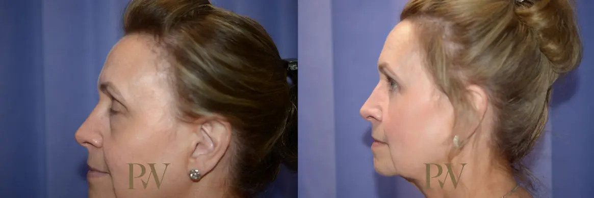 Paul Wilson - Mid-Face Lift Patient Image 7