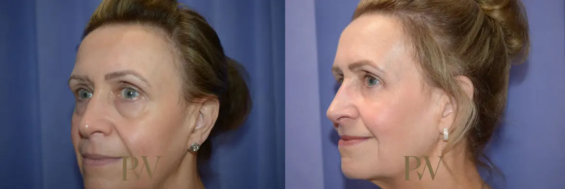 Paul Wilson - Mid-Face Lift Patient Image 8