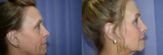 Paul Wilson - Mid-Face Lift Patient Image 9