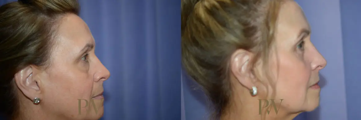 Paul Wilson - Mid-Face Lift Patient Image 9