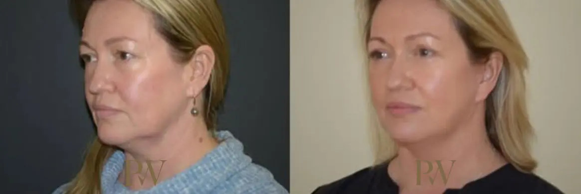 Paul Wilson - Neck Lift Patient Image 10