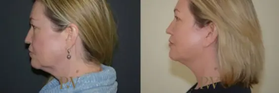 Paul Wilson - Neck Lift Patient Image 11