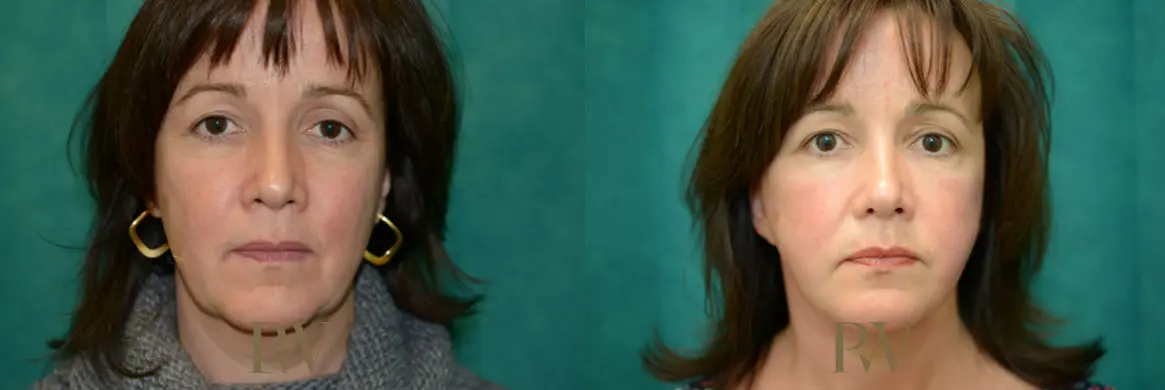 Paul Wilson - Neck Lift Patient Image 12