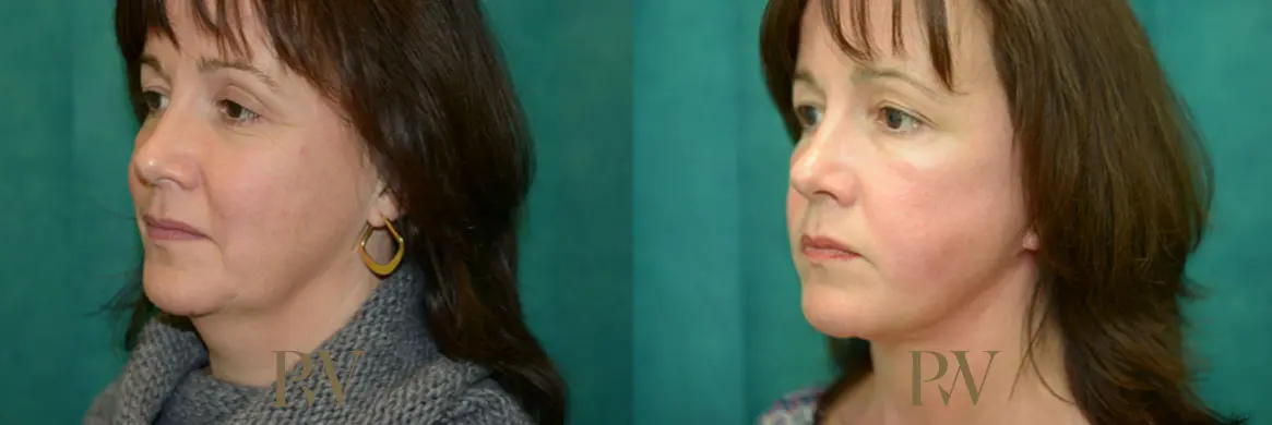 Paul Wilson - Neck Lift Patient Image 14