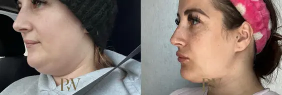 Paul Wilson - Neck Lift Patient Image 15