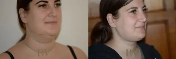 Paul Wilson - Neck Lift Patient Image 16