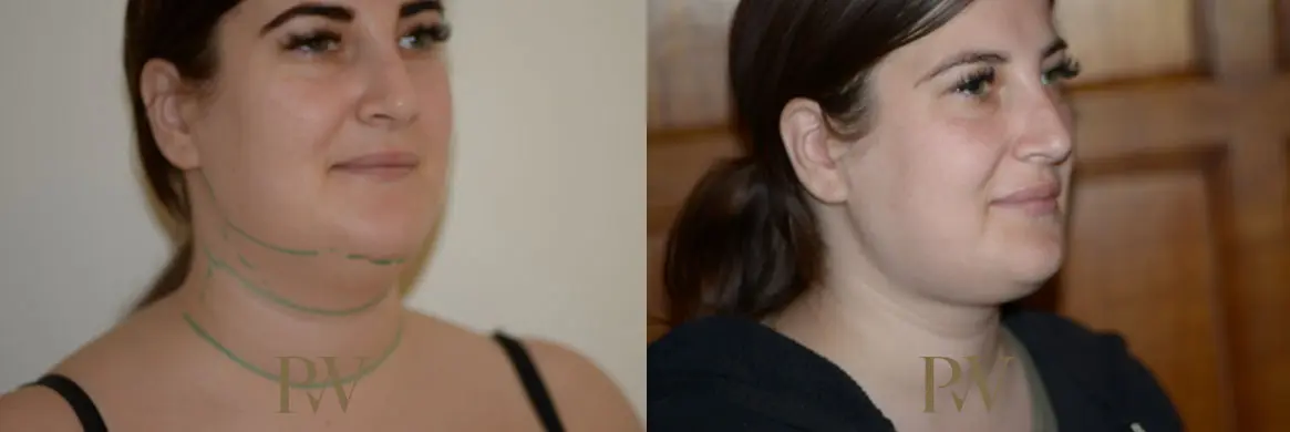 Paul Wilson - Neck Lift Patient Image 16