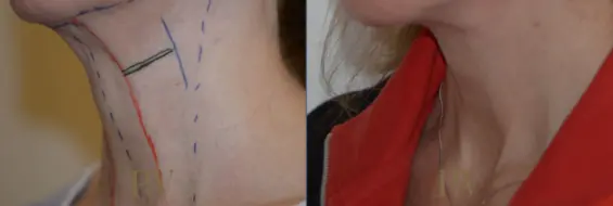 Paul Wilson - Neck Lift Patient Image 2