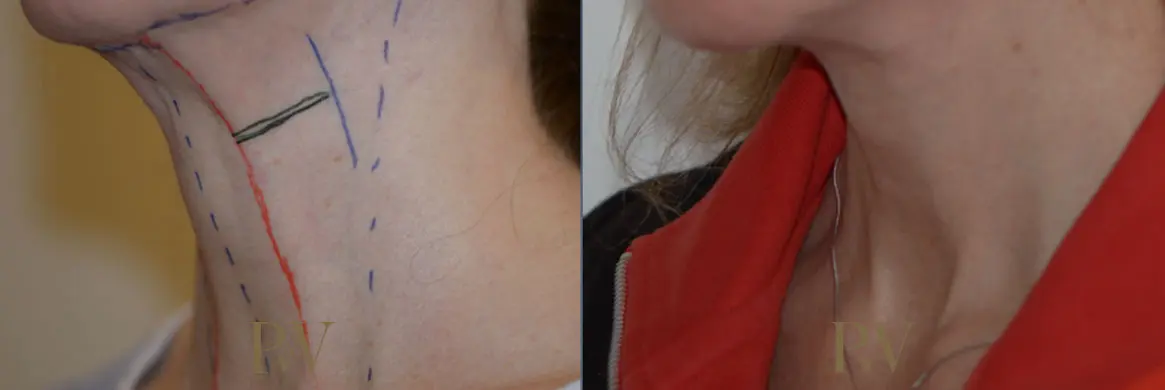 Paul Wilson - Neck Lift Patient Image 2