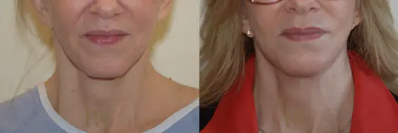 Paul Wilson - Neck Lift Patient Image 3