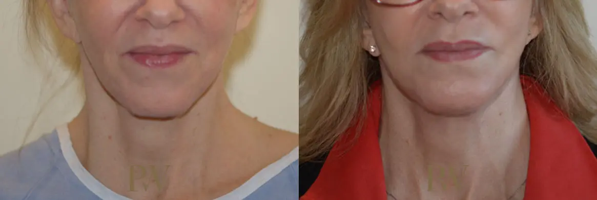 Paul Wilson - Neck Lift Patient Image 3