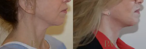 Paul Wilson - Neck Lift Patient Image 4