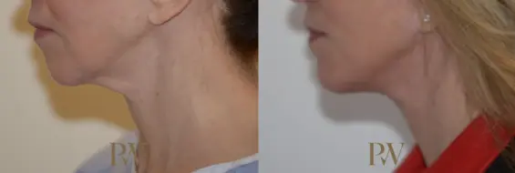 Paul Wilson - Neck Lift Patient Image 5