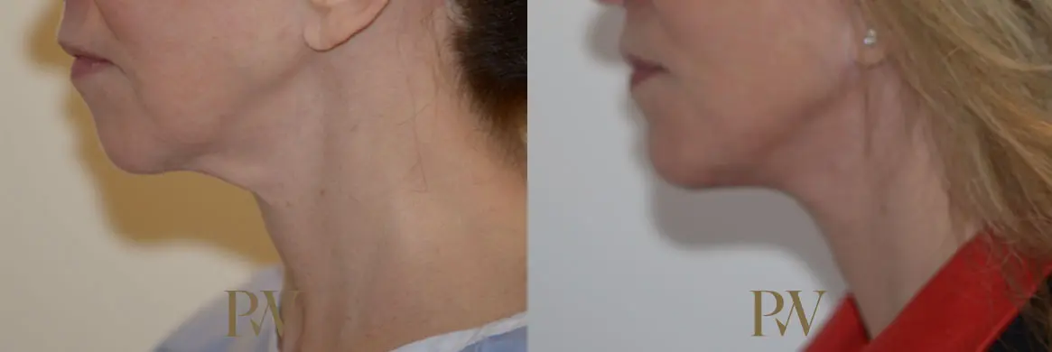 Paul Wilson - Neck Lift Patient Image 5