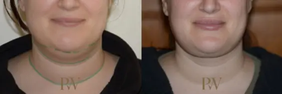 Paul Wilson - Neck Lift Patient Image 6