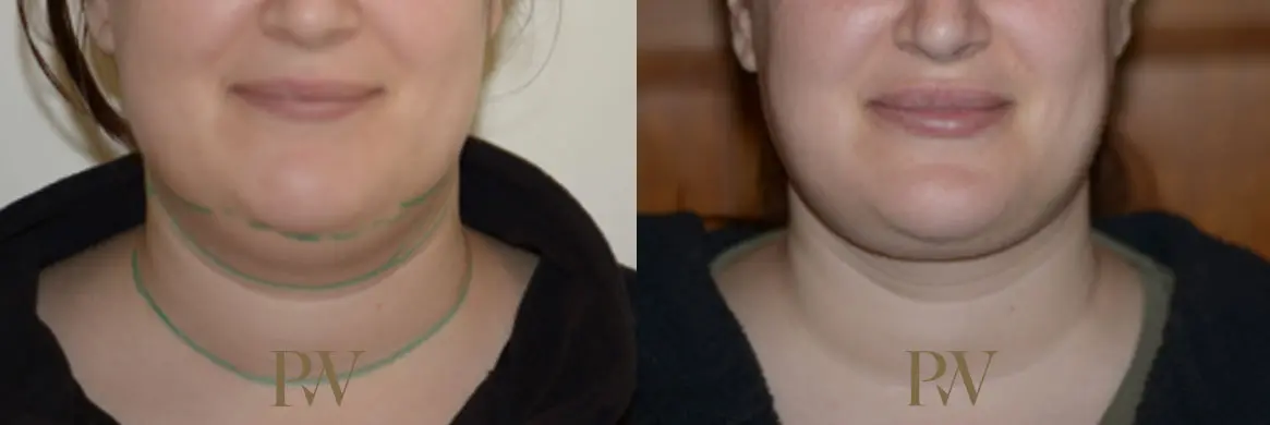 Paul Wilson - Neck Lift Patient Image 6