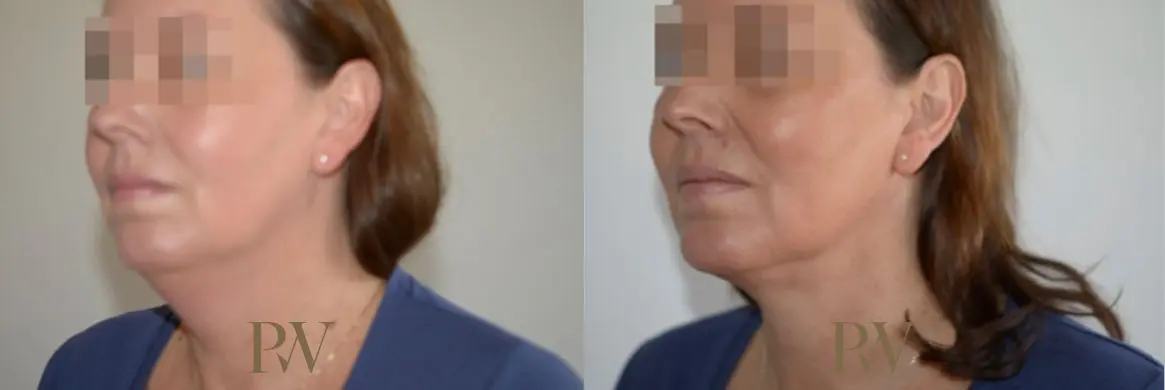 Paul Wilson - Neck Lift Patient Image 7