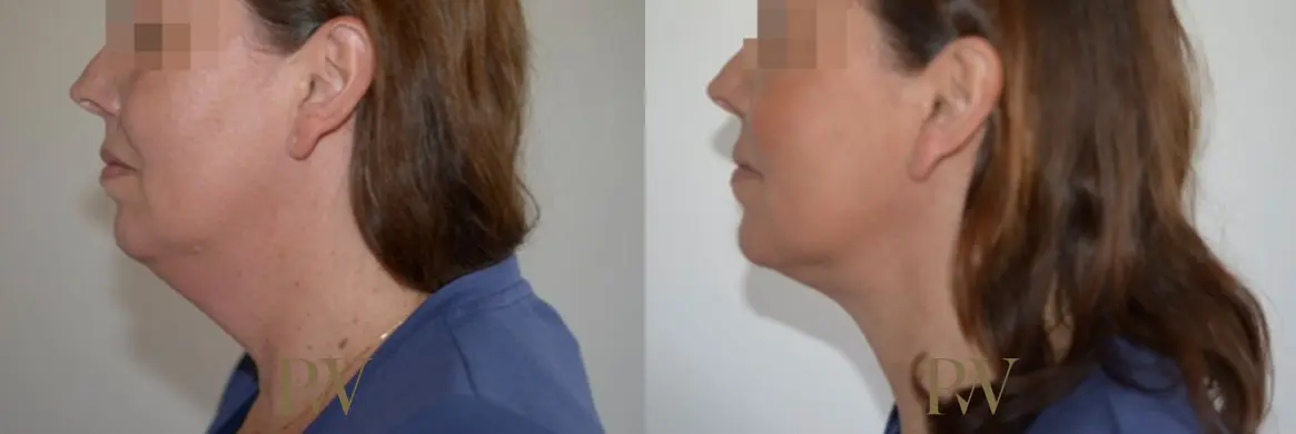 Paul Wilson - Neck Lift Patient Image 8