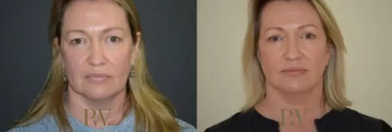 Paul Wilson - Neck Lift Patient Image 9