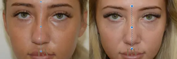 Paul Wilson - Rhinoplasty Patient Image 1