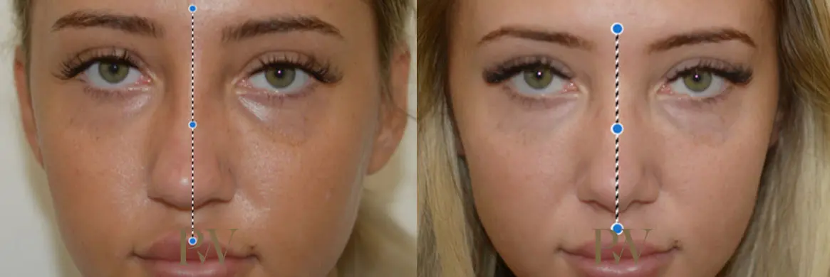 Paul Wilson - Rhinoplasty Patient Image 1