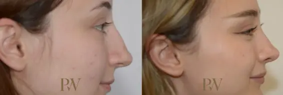 Paul Wilson - Rhinoplasty Patient Image 10