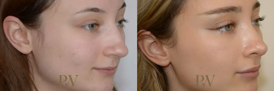 Paul Wilson - Rhinoplasty Patient Image 11