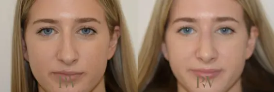 Paul Wilson - Rhinoplasty Patient Image 12