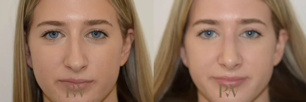 Paul Wilson - Rhinoplasty Patient Image 12