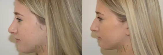 Paul Wilson - Rhinoplasty Patient Image 13