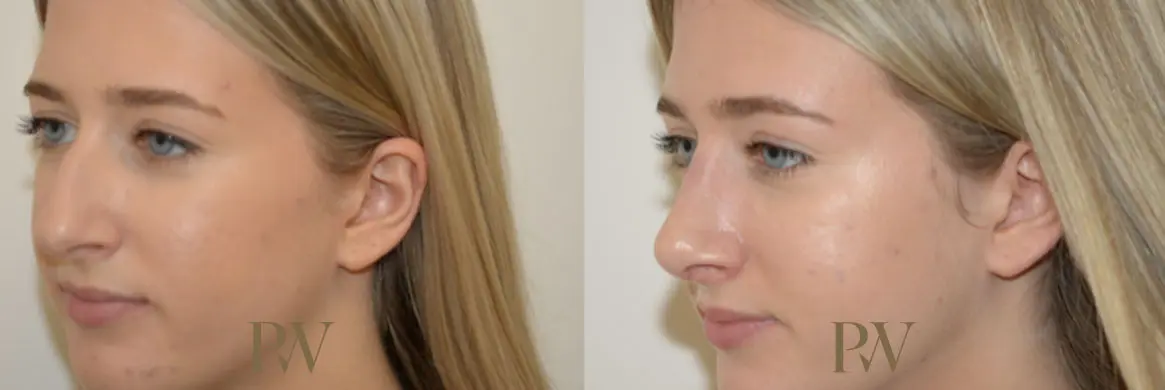 Paul Wilson - Rhinoplasty Patient Image 14