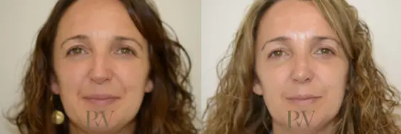 Paul Wilson - Rhinoplasty Patient Image 15