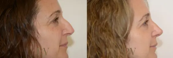 Paul Wilson - Rhinoplasty Patient Image 16